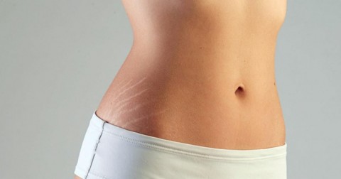 Rạn da và những điều bạn cần biết